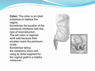 Colon: The colon is an ideal
substitute to replace the
vagina.
Sometimes the location of the
colostomy interferes with this
type of reconstruction.
The left colon or sigmoid
work well because their
arcades reach the perineum
nicely.
Sometimes taking
the colostomy down and
using its distal segment for
the vaginal graft is a helpful
maneuver.
 