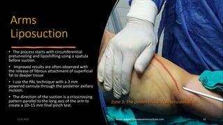 Arms and Axilla Liposuction.pptx