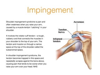 Impingement
Shoulder impingement syndrome is pain and
often weakness when you raise your arm,
caused by a muscle tendon "catching" in your
shoulder.

!
It involves the rotator cuﬀ tendon – a tough,
rubbery cord that connects the muscles in
your shoulder to the top of your arm. The
tendon and muscle run through a narrow
space at the top of the shoulder called the
subacromial space.

!
In shoulder impingement syndrome, the
tendon becomes trapped in this space and
repeatedly scrapes against the bone above,
causing pain that tends to be worse when you
raise your arm over your head. NHS
 