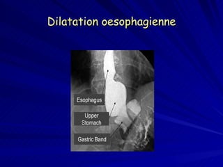 Dilatation oesophagienne 
