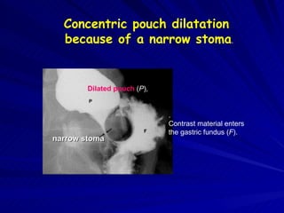 Concentric pouch dilatation because of a narrow stoma . .  Contrast material enters  the gastric fundus ( F ).  Dilated pouch  ( P ), narrow stoma   