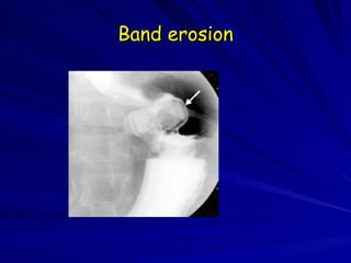 Band erosion 