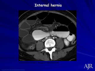 Copyright © 2007 by the American Roentgen Ray Society Lockhart, M. E. et al. Am. J. Roentgenol. 2007;188:745-750 -- Internal hernia 