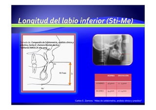 Carlos E. Zamora. “Atlas de cefalometría, análisis clínico y practico”
Tomado de: Compendio de Cefalometría, análisis clínico y
práctico, Carlos E. Zamora Montes de Oca
*editorial AMOLCA año 2004
 