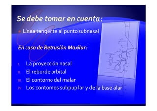 Línea tangente al punto subnasal
En caso de Retrusión Maxilar:
I. La proyección nasal
II. El reborde orbital
III. El contorno del malar
IV. Los contornos subpupilar y de la base alar
 