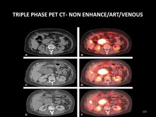 TRIPLE PHASE PET CT- NON ENHANCE/ART/VENOUS
115
 