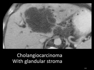 Cholangiocarcinoma
With glandular stroma
 