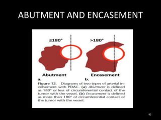 ABUTMENT AND ENCASEMENT
92
 