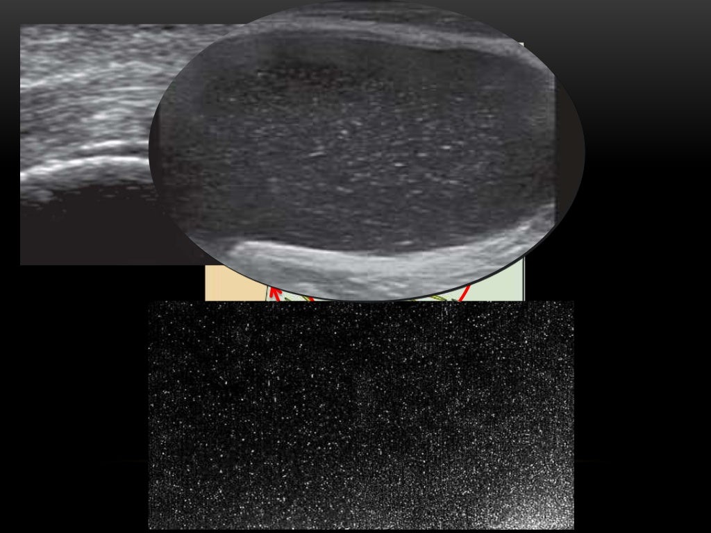 Crystal arthropathies; Pearls for MSK Ultrasound practitioners
