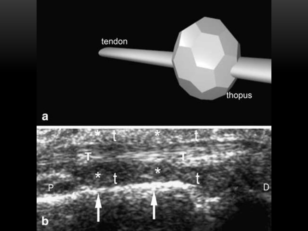 Crystal arthropathies; Pearls for MSK Ultrasound practitioners