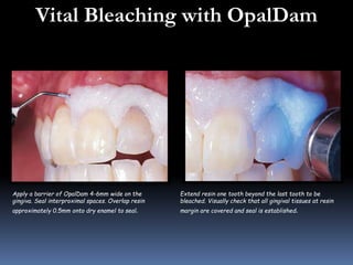Rinse and suction to evaluate color 
change and 
determine if additional whitening is 
necessary. 
Cured OpalDam resin is ...
