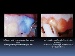 Insti dam 
Advantages: 
• Compact design fits outside patients 
mouth. 
• Built-in flexible frame, with pre-punched 
hole ...