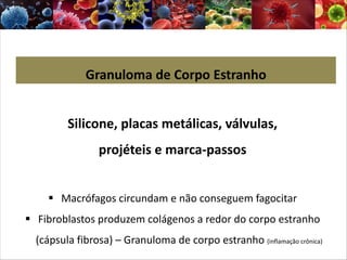 Granuloma de Corpo Estranho
Silicone, placas metálicas, válvulas,
projéteis e marca-passos
§ Macrófagos circundam e não conseguem fagocitar
§ Fibroblastos produzem colágenos a redor do corpo estranho
(cápsula fibrosa) – Granuloma de corpo estranho (inflamação crônica)
 