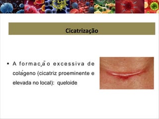 § A f o r m a c ̧ a ̃ o e x c e s s i v a d e
colágeno (cicatriz proeminente e
elevada no local): queloide
Cicatrização
 