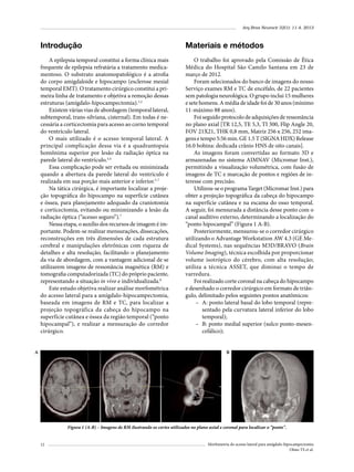 Arq Bras Neurocir 32(1): 11-4, 2013

Introdução

Materiais e métodos

A epilepsia temporal constitui a forma clínica mais
frequente de epilepsia refratária a tratamento medicamentoso. O substrato anatomopatológico é a atrofia
do corpo amigdaloide e hipocampo (esclerose mesial
temporal EMT). O tratamento cirúrgico constitui a primeira linha de tratamento e objetiva a remoção dessas
estruturas (amígdalo-hipocampectomia).1,2
Existem várias vias de abordagem (temporal lateral,
subtemporal, trans-silviana, cisternal). Em todas é necessária a corticectomia para acesso ao corno temporal
do ventrículo lateral.
O mais utilizado é o acesso temporal lateral. A
principal complicação dessa via é a quadrantopsia
homônima superior por lesão da radiação óptica na
parede lateral do ventrículo.3,4
Essa complicação pode ser evitada ou minimizada
quando a abertura da parede lateral do ventrículo é
realizada em sua porção mais anterior e inferior.5-7
Na tática cirúrgica, é importante localizar a projeção topográfica do hipocampo na superfície cutânea
e óssea, para planejamento adequado da craniotomia
e corticectomia, evitando ou minimizando a lesão da
radiação óptica (“acesso seguro”).7
Nessa etapa, o auxílio dos recursos de imagem é importante. Podem-se realizar mensurações, dissecações,
reconstruções em três dimensões de cada estrutura
cerebral e manipulações eletrônicas com riqueza de
detalhes e alta resolução, facilitando o planejamento
da via de abordagem, com a vantagem adicional de se
utilizarem imagens de ressonância magnética (RM) e
tomografia computadorizada (TC) do próprio paciente,
representando a situação in vivo e individualizada.8
Este estudo objetiva realizar análise morfométrica
do acesso lateral para a amígdalo-hipocampectomia,
baseada em imagens de RM e TC, para localizar a
projeção topográfica da cabeça do hipocampo na
superfície cutânea e óssea da região temporal (“ponto
hipocampal”), e realizar a mensuração do corredor
cirúrgico.

O trabalho foi aprovado pela Comissão de Ética
Médica do Hospital São Camilo Santana em 23 de
março de 2012.
Foram selecionados do banco de imagens do nosso
Serviço exames RM e TC de encéfalo, de 22 pacientes
sem patologia neurológica. O grupo inclui 15 mulheres
e sete homens. A média de idade foi de 30 anos (mínimo
11-máximo 88 anos).
Foi seguido protocolo de adquisições de ressonância
no plano axial [TR 12,5, TE 5,3, TI 300, Flip Angle 20,
FOV 21X21, THK 0,8 mm, Matriz 256 x 256, 252 imagens e tempo 5:56 min. GE 1.5 T (SIGNA HDX) Release
16.0 bobina: dedicada crânio HNS de oito canais].
As imagens foram convertidas ao formato 3D e
armazenadas no sistema AIMNAV (Micromar Inst.),
permitindo a visualização volumétrica, com fusão de
imagens de TC e marcação de pontos e regiões de interesse com precisão.
Utilizou-se o programa Target (Micromar Inst.) para
obter a projeção topográfica da cabeça do hipocampo
na superfície cutânea e na escama do osso temporal.
A seguir, foi mensurada a distância desse ponto com o
canal auditivo externo, determinando a localização do
“ponto hipocampal” (Figura 1 A-B).
Posteriormente, mensurou-se o corredor cirúrgico
utilizando o Advantage Workstation AW 4.3 (GE Medical Systems), nas sequências M3D/BRAVO (Brain
Volume Imaging), técnica escolhida por proporcionar
volume isotrópico do cérebro, com alta resolução;
utiliza a técnica ASSET, que diminui o tempo de
varredura.
Foi realizado corte coronal na cabeça do hipocampo
e desenhado o corredor cirúrgico em formato de triângulo, delimitado pelos seguintes pontos anatômicos:
–	 A: ponto lateral basal do lobo temporal (representado pela curvatura lateral inferior do lobo
temporal);
–	 B: ponto medial superior (sulco ponto-mesencefálico);

A

B

Figura 1 (A-B) – Imagens de RM ilustrando os cortes utilizados no plano axial e coronal para localizar o “ponto".
12

Morfometria do acesso lateral para amígdalo-hipocampectomia
Olmo TS et al.

 