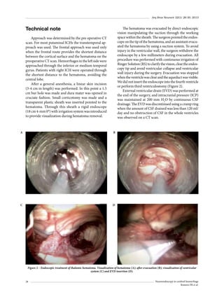 Arq Bras Neurocir 32(1): 26-30, 2013

Technical note

The hematoma was evacuated by direct endoscopic
vision manipulating the suction through the working
space within the sheath. The surgeon pointed the endoscope on the tip of the hematoma, and an assistant evacuated the hematoma by using a suction system. To avoid
injury in the ventricular wall, the surgeon withdrew the
endoscope by a few millimeters during evacuation. All
procedure was performed with continuous irrigation of
Ringer Solution (RS) to clarify the vision, clear the endoscopy tip and avoid ventricular collapse and ventricular
wall injury during the surgery. Evacuation was stopped
when the ventricle was clear and the aqueduct was visible.
We did not insert the endoscope into the fourth ventricle
or perform third ventriculostomy (Figure 2).
External ventricular drain (EVD) was performed at
the end of the surgery, and intracranial pressure (ICP)
was maintained at 200 mm H2O by continuous CSF
drainage. The EVD was discontinued using a cramp ring
when the amount of CSF drained was less than 120 ml/
day and no obstruction of CSF in the whole ventricles
was observed on a CT scan.

Approach was determined by the pre operative CT
scan. For most putaminal ICHs the transtemporal approach was used. The frontal approach was used only
when the frontal route provides the shortest distance
between the cortical surface and the hematoma on the
preoperative CT scan. Hemorrhages in the left side were
approached through the inferior or medium temporal
gyrus. Patients with right ICH were operated through
the shortest distance to the hematoma, avoiding the
central lobe.
After a general anesthesia, a linear skin incision
(3-4 cm in length) was performed. In this point a 1.5
cm bur hole was made and dura mater was opened in
cruciate fashion. Small corticotomy was made and a
transparent plastic sheath was inserted pointed to the
hematoma. Through this sheath a rigid endoscope
(18 cm 4-mm 0°) with irrigation system was introduced
to provide visualization during hematoma removal.

A

B

C

D

Figure 2 – Endoscopic treatment of thalamic hematoma. Visualization of hematoma (A); after evacuation (B); visualization of ventricular
system (C) and EVD insertion (D).
28

Neuroendoscopy in cerebral hemorrhage
Romero FR et al.

 