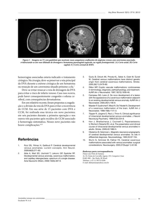 Arq Bras Neurocir 32(1): 37-9, 2013

A

B

C

Figura 1 – Imagens no T1 com gadolínio que mostram vasos sanguíneos confluentes do angioma venoso com cavernoma associado,
evidenciando-se um vaso dilatado de drenagem e hematoma parassagital esquerdo, na região frontoparietal. (A) Corte axial; (B) Corte
sagital; (C) Corte coronal de RMN.

hemorragias associadas estaria indicado o tratamento
cirúrgico. Na cirurgia, deve-se preservar a veia principal
da DVA durante a exérese cirúrgica de um hematoma
ou resseção de um cavernoma situado próximo a ela.1
Deve-se evitar ressecar a veia de drenagem da DVA
para evitar o risco de infarto venoso. Caso isso ocorra,
pode haver consequentemente congestão e edema cerebral, com consequências devastadoras.
Em um relatório recente, foram propostas a coagulação e a divisão da veia da DVA para evitar a recorrência
do CCM. Em sua série de 15 pacientes com DVA e
CCM, foi realizada essa técnica em nove pacientes;
em seis pacientes durante a primeira operação e nos
outros três pacientes após recidiva do CCM associado
à hemorragia sintomática. Nesses nove pacientes não
houve complicações.8,10

3.	

4.	

5.	

6.	

7.	

8.	

9.	

Referências
1.	

2.	

Ruíz DS, Yilmaz H, Gailloud P. Cerebral developmental
venous anomalies: current concepts. Ann Neurol.
2009;66(3):271-83.
Abla A, Wait SD, Uschold T, Lekovic GP, Spetzler RF.
Developmental venous anomaly, cavernous malformation,
and capillary telangiectasia: spectrum of a single disease.
Acta Neurochir (Wien). 2008;150(5):487-9.

Anomalias venosas nos cavernomas
Escalante W et al.

10.	

Guclu B, Ozturk AK, Pricola KL, Seker A, Ozek M, Gunel
M. Cerebral venous malformations have distinct genetic
origin from cerebral cavernous malformations. Stroke.
2005;36(11):2479-80.
Dillon WP. Cryptic vascular malformations: controversies
in terminology, diagnosis, pathophysiology, and treatment.
AJNR Am J Neuroradiol. 1997;18(10):1839-46.
Campeau NG, Lane JI. De novo development of a lesion
with the appearance of a cavernous malformation adjacent
to an existing developmental venous anomaly. AJNR Am J
Neuroradiol. 2005;26(1):156-9.
Maeder P, Gudinchet F, Meuli R, De Tribolet N. Development
of a cavernous malformation of the brain. AJNR Am J
Neuroradiol. 1998;19(6):1141-3.
Töpper R, Jürgens E, Reul J, Thron A. Clinical significance
of intracranial developmental venous anomalies. J Neurol
Neurosurg Psychiatry. 1999;67(2):234-8.
Hon J, Bhattacharya J, Counsell C, Papanastassiou
V, Ritchie V, Roberts RC, et al. The presentation and clinical
course of intracranial developmental venous anomalies in
adults. Stroke. 2009;40:1980-5.
Obstertun B, Solymosi L. Magnetic resonance angiography
of cerebral developmental venous anomalies: its role in
differential diagnosis. Neuroradiology. 1993;35:97-104.
Wurm G, Schnizer M, Fellner FA. Cerebral cavernous
malformations associated with venous anomalies: surgical
considerations. Neurosurgery. 2005;57(Suppl 1):42-58.

Endereço para correspondência
Diana Lara Pinto de Santana
Av. Dr. Enéas de Carvalho Aguiar, 255, Cerqueira César
05403-000 – São Paulo, SP, Brasil
Telefone: (+55 11) 99733-0208
E-mail: didisantana@yahoo.com.br

39

 
