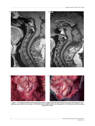 Arq Bras Neurocir 32(1): 40-7, 2013

A

B

C

D

Figure 1 – (A) Preoperative MRI demonstrating impacted cisterna magna without SM and with the presence of BI. (B) Postoperative MRI
depicting a large artificial cisterna magna. (C) Herniation of the cerebellar tonsils in the sitting position. (D) Tonsillectomy and large opening
of the fourth ventricle.

42

Impacted cisterna magna without syringomyelia
Silva JAG et al.

 