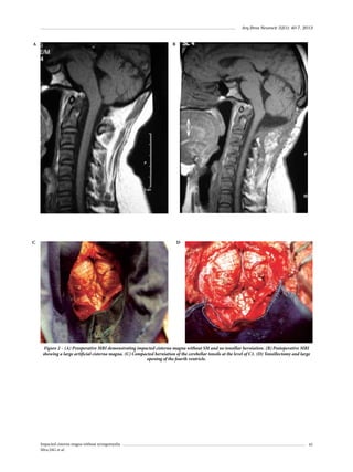 Arq Bras Neurocir 32(1): 40-7, 2013

A

B

C

D

Figure 2 – (A) Preoperative MRI demonstrating impacted cisterna magna without SM and no tonsillar herniation. (B) Postoperative MRI
showing a large artificial cisterna magna. (C) Compacted herniation of the cerebellar tonsils at the level of C1. (D) Tonsillectomy and large
opening of the fourth ventricle.

Impacted cisterna magna without syringomyelia
Silva JAG et al.

43

 