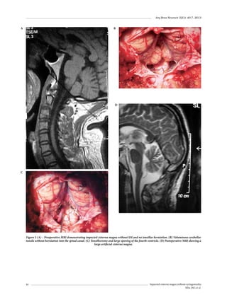 Arq Bras Neurocir 32(1): 40-7, 2013

B

A

D

C

Figure 3 (A) – Preoperative MRI demonstrating impacted cisterna magna without SM and no tonsillar herniation. (B) Voluminous cerebellar
tonsils without herniation into the spinal canal. (C) Tonsillectomy and large opening of the fourth ventricle. (D) Postoperative MRI showing a
large artificial cisterna magna.

44

Impacted cisterna magna without syringomyelia
Silva JAG et al.

 