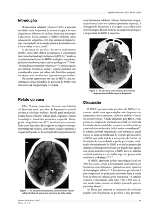 Arq Bras Neurocir 32(1): 48-50, 2013

Introdução
O hematoma subdural crônico (HSDC) é uma das
entidades mais frequentes da neurocirurgia, e os seus
diagnósticos diferenciais incluem demência, meningite
e abscessos.1 Classicamente, o HSDC é definido como
uma coleção sanguínea, com grau variado de degeneração, encapsulado, de evolução crônica, localizado entre
a dura-máter e a aracnoide.2-5
A presença de paralisia do nervo oculomotor
(NOM) sem outro déficit neurológico é considerada
rara como forma de apresentação em HSDC,6,7 sendo as
manifestações clínicas do HSDC múltiplas e complexas,
podendo simular outros processos patológicos.5,8,9 Pode-se manifestar com crises epilépticas10,11 e variados graus
de confusão mental ou coma.11 Alguns pacientes são
considerados como portadores de distúrbios psiquiátricos por causa dos sintomas depressivos e paranoides.2
Os autores apresentam um caso de HSDC cuja manifestação clínica inicial foi de paralisia do NOM. Eles
discutem sua fisiopatologia e conduta.

com hematoma subdural crônico. Submetido à trepanação frontal anterior e parietal posterior esquerda, à
drenagem do hematoma e à lavagem da cavidade com
soro fisiológico. Houve melhora do quadro neurológico
e da paralisia do NOM à esquerda.

Figura 2 – TC de crânio sem contraste, apresentando
comprometimento lobo temporal à esquerda.

Relato do caso
RTA, 79 anos, masculino. Paciente com história
de demência senil, portador de hipertensão arterial
sistêmica e diabetes mellitus. Estado geral: moderado.
Exame físico: péssimo estado geral, eupneico. Exame
neurológico: sonolento, anisocoria esquerda. Tomagrafia computadorizada (TC) de crânio sem contraste:
lesão com densidade heterogênea na região frontoparietotemporal bilateral com maior coleção subdural à
esquerda (Figuras 1 e 2), compatível tomograficamente

Figura 1 – TC de crânio sem contraste, demonstrando coleção
subdural bilateral, desvio das estruturas da linha média.
Paralisia do NOM em HSDC
Pereira CU et al.

Discussão
O HSDC apresentando paralisia do NOM é incomum, sendo uma apresentação mais frequente em
aneurismas intracranianos, diabetes mellitus e lesão
no seio cavernoso.7 A lesão expansiva pelo HSDC pode
provocar compressão do tronco cerebral por meio da
herniação do uncus do lobo temporal, manifestando-se
com midríase unilateral e déficit motor contralateral.12
O edema cerebral relacionado com herniação uncal
exerce, ao longo da borda livre do tentório, pressão sobre
o NOM, que pode levá-lo a uma perda de função.7 A
herniação do uncus desvia a ponte para baixo, resultando no estiramento do NOM e no deslocamento das
artérias cerebrais posteriores em um ângulo mais agudo;
esse deslocamento comprime o NOM entre as artérias
cerebral posterior e a cerebelar superior, provocando
midríase e iridoplegia.1,4,13-16
O HSDC apresenta déficit neurológico focal em
58% dos casos, sendo a hemiparesia contralateral ao
hematoma mais frequente, podendo ocorrer quadros
de hemiplegias súbitas.2,3 A hemiparesia geralmente é
por compressão do pedúnculo cerebral contra a borda
livre do tentório exercida pelo hematoma.2 A cefaleia
noturna e lateralizada varia entre 14% e 80% dos casos, sendo mais comum em adultos jovens do que em
pacientes idosos.2
As fibras que inervam os músculos do esfíncter
pupilar estão localizadas na periferia e são, portanto,
49

 
