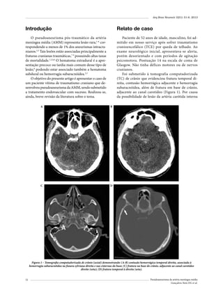 Arq Bras Neurocir 32(1): 51-6, 2013

Introdução

Relato de caso

O pseudoaneurisma pós-traumático da artéria
meníngea média (AMM) representa lesão rara,1-6 correspondendo a menos de 1% dos aneurismas intracranianos.2,3 Tais lesões estão associadas principalmente a
fraturas cranianas traumáticas,7-9 possuindo altas taxas
de mortalidade.1,2,4,6 O hematoma extradural é a apresentação precoce ou tardia mais comum desse tipo de
lesão,8 podendo estar associado também a hematoma
subdural ou hemorragia subaracnóidea.2,3
O objetivo do presente artigo é apresentar o caso de
um paciente vítima de traumatismo craniano que desenvolveu pseudoaneurisma da AMM, sendo submetido
a tratamento endovascular com sucesso. Realizou-se,
ainda, breve revisão da literatura sobre o tema.

Paciente de 52 anos de idade, masculino, foi admitido em nosso serviço após sofrer traumatismo
cranioencefálico (TCE) por queda de telhado. Ao
exame neurológico inicial, apresentava-se alerta,
porém desorientado e com períodos de agitação
psicomotora. Pontuação 14 na escala de coma de
Glasgow. Não tinha défices motores ou de nervos
cranianos.
Foi submetido à tomografia computadorizada
(TC) de crânio que evidenciou fratura temporal direita, contusão hemorrágica adjacente e hemorragia
subaracnóidea, além de fratura em base de crânio,
adjacente ao canal carotídeo (Figura 1). Por causa
da possibilidade de lesão da artéria carótida interna

A

B

C

D

Figura 1 – Tomografia computadorizada de crânio (axial) demonstrando: (A-B) contusão hemorrágica temporal direita, associada à
hemorragia subaracnóidea na fissura sylviana direita e nas cisternas da base; (C) fratura na base do crânio, adjacente ao canal carotídeo
direito (seta); (D) fratura temporal à direita (seta).
52

Pseudoaneurisma da artéria meníngea média
Gonçalves Neto DG et al.

 