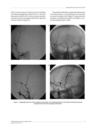 Arq Bras Neurocir 32(1): 51-6, 2013

(ACI) em decorrência da fratura do canal carotídeo,
foi realizada angiografia cerebral (AGC). A AGC não
demonstrou lesão da ACI, porém mostrou pseudoaneurisma na artéria meníngea média direita, adjacente
à fratura temporal (Figura 2).

O paciente foi submetido a tratamento endovascular,
sem intercorrências, com embolização do aneurisma
por meio de espiras (coils) (Figura 3). Apresentou boa
evolução, com melhora do quadro neurológico, e recebeu alta hospitalar após 12 dias.

A

B

C

D

Figura 2 – Angiografia seletiva de artéria carótida externa direita. (A-B) incidência frontal; (C-D) incidência lateral demonstrando
pseudoaneurisma da artéria meníngea média direita.

Pseudoaneurisma da artéria meníngea média
Gonçalves Neto DG et al.

53

 