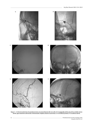 Arq Bras Neurocir 32(1): 51-6, 2013

A

B

C

D

E

F

Figura 3 – (A-B) microcateterismo do pseudoaneurisma com preenchimento dele com coils; (C-F) angiografia seletiva da artéria carótida externa
direita, após tratamento endovascular, demonstrando completa oclusão do aneurisma; (C-D) incidência frontal; (E-F) incidência lateral.
54

Pseudoaneurisma da artéria meníngea média
Gonçalves Neto DG et al.

 