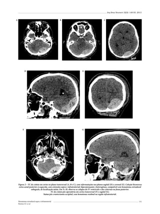 Arq Bras Neurocir 32(3): 149-55, 2013

A

B

D

F

C

E

G

Figura 2 – TC do crânio em cortes no plano transversal (A, B e C), com reformatações nos planos sagital (D) e coronal (E). Coleção biconvexa
extra-axial posterior à esquerda, com extensões supra e infratentorial, hiperatenuante e heterogênea, compatível com hematoma extradural
subagudo, de localização mista. Em A e B, observa-se colapso do IV ventrículo e das cisternas na fossa posterior.
TC do crânio pós-operatória em cortes transversal (F) e sagital (G).
Status pós-craniectomia occipital, com hematoma residual na região infratentorial.
Hematoma extradural supra e infratentorial
Pereira CU et al.

151

 