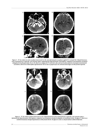 Arq Bras Neurocir 32(3): 149-55, 2013

A

B

C

D

Figura 3 – TC do crânio em cortes no plano transversal (A e B), com reformatações nos planos sagital (C) e coronal (E). Coleção biconvexa
extra-axial posterior à esquerda, com extensões supra e infratentorial, hiperatenuante e heterogênea, compatível com hematoma extradural
subagudo, de localização mista. Em A e B, observa-se colapso do IV ventrículo e das cisternas na fossa posterior, herniação transtentorial
ascendente, além de leve hidrocefalia supratentorial. Em B, nota-se pequeno foco de contusão hemorrágica no lobo frontal esquerdo.
A

B

C

D

Figura 4 – TC do crânio no plano transversal (A-D). Coleção biconvexa extra-axial posterior à esquerda, com extensões supra e
infratentorial, hiperatenuante e heterogênea, compatível com hematoma extradural subagudo, de localização mista. Na figura C, observa-se
também hematoma intraparenquimatoso no lobo frontal direito. Na figura D, nota-se coleção laminar subdural bifrontal.
152

Hematoma extradural supra e infratentorial
Pereira CU et al.

 