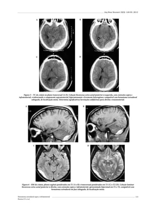 Arq Bras Neurocir 32(3): 149-55, 2013

A

B

C

D

Figura 5 – TC do crânio no plano transversal (A-D). Coleção biconvexa extra-axial posterior à esquerda, com extensões supra e
infratentorial, evidenciando o componente supratentorial, hiperatenuante e levemente heterogêneo, compatível com hematoma extradural
subagudo, de localização mista. Determina significativas herniações subfalcinas para direita e transtentorial.
A

B

C

D

Figura 6 – RM do crânio, planos sagitais ponderados em T1 (A e B) e transversais ponderados em T1 (C) e T2 (D). Coleção laminar
biconvexa extra-axial posterior à direita, com extensões supra e infratentorial, apresentando hipersinal em T1 e T2, compatível com
hematoma extradural em fase subaguda, de localização mista.
Hematoma extradural supra e infratentorial
Pereira CU et al.

153

 