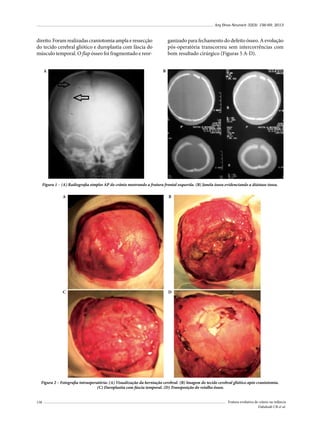 Arq Bras Neurocir 32(3): 156-69, 2013

direito. Foram realizadas craniotomia ampla e ressecção
do tecido cerebral gliótico e duroplastia com fáscia do
músculo temporal. O flap ósseo foi fragmentado e reor-

ganizado para fechamento do defeito ósseo. A evolução
pós-operatória transcorreu sem intercorrências com
bom resultado cirúrgico (Figuras 5 A-D).
B

A

Figura 1 – (A) Radiografia simples AP do crânio mostrando a fratura frontal esquerda. (B) Janela óssea evidenciando a diástase óssea.
A

B

C

D

Figura 2 – Fotografia intraoperatória: (A) Visualização da herniação cerebral. (B) Imagem do tecido cerebral gliótico após craniotomia.
(C) Duroplastia com fáscia temporal. (D) Transposição do retalho ósseo.
158

Fratura evolutiva de crânio na infância
Dabdoub CB et al.

 