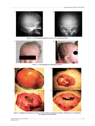 Arq Bras Neurocir 32(3): 156-69, 2013

A

B

Figura 3 – (A, B) Radiografias simples do crânio em AP e perfil pós-operatório.
A

B

Figura 4 – (A, B) Fotografias do resultado pós-operatório.
A

B

C

D

Figura 5 – Fotografia intraoperatória mostrando: (A) Massa saliente em região parietal direita. (B) Falha óssea. (C) Duroplastia.
(D) Transposição do retalho ósseo.
Fratura evolutiva de crânio na infância
Dabdoub CB et al.

159

 