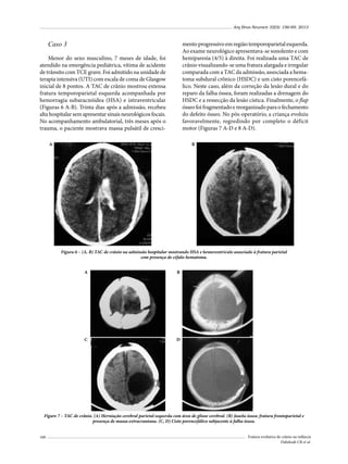 Arq Bras Neurocir 32(3): 156-69, 2013

Caso 3

mento progressivo em região temporoparietal esquerda.
Ao exame neurológico apresentava-se sonolento e com
hemiparesia (4/5) à direita. Foi realizada uma TAC de
crânio visualizando-se uma fratura alargada e irregular
comparada com a TAC da admissão, associada a hematoma subdural crônico (HSDC) e um cisto porencefálico. Neste caso, além da correção da lesão dural e do
reparo da falha óssea, foram realizadas a drenagem do
HSDC e a ressecção da lesão cística. Finalmente, o flap
ósseo foi fragmentado e reorganizado para o fechamento
do defeito ósseo. No pós-operatório, a criança evoluiu
favoravelmente, regredindo por completo o déficit
motor (Figuras 7 A-D e 8 A-D).

Menor do sexo masculino, 7 meses de idade, foi
atendido na emergência pediátrica, vítima de acidente
de trânsito com TCE grave. Foi admitido na unidade de
terapia intensiva (UTI) com escala de coma de Glasgow
inicial de 8 pontos. A TAC de crânio mostrou extensa
fratura temporoparietal esquerda acompanhada por
hemorragia subaracnóidea (HSA) e intraventricular
(Figuras 6 A-B). Trinta dias após a admissão, recebeu
alta hospitalar sem apresentar sinais neurológicos focais.
No acompanhamento ambulatorial, três meses após o
trauma, o paciente mostrava massa pulsátil de cresciA

B

Figura 6 – (A, B) TAC de crânio na admissão hospitalar mostrando HSA e hemoventrículo associado à fratura parietal
com presença de céfalo-hematoma.
A

B

C

D

Figure 7 – TAC de crânio. (A) Herniação cerebral parietal esquerda com área de gliose cerebral. (B) Janela óssea: fratura frontoparietal e
presença de massa extracraniana. (C, D) Cisto porencefálico subjacente à falha óssea.
160

Fratura evolutiva de crânio na infância
Dabdoub CB et al.

 