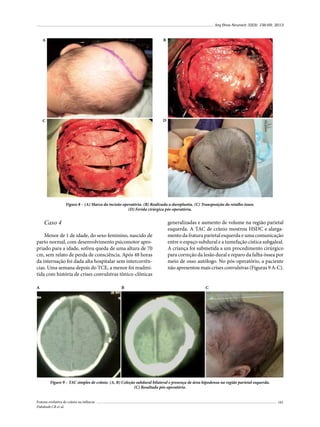 Arq Bras Neurocir 32(3): 156-69, 2013

B

A

B

D

C

Figure 8 – (A) Marca da incisão operatória. (B) Realizada a duroplastia. (C) Transposição do retalho ósseo.
(D) Ferida cirúrgica pós-operatória.

Caso 4
Menor de 1 de idade, do sexo feminino, nascido de
parto normal, com desenvolvimento psicomotor apropriado para a idade, sofreu queda de uma altura de 70
cm, sem relato de perda de consciência. Após 48 horas
da internação foi dada alta hospitalar sem intercorrências. Uma semana depois do TCE, a menor foi readmitida com história de crises convulsivas tônico-clônicas
A

B

generalizadas e aumento de volume na região parietal
esquerda. A TAC de crânio mostrou HSDC e alargamento da fratura parietal esquerda e uma comunicação
entre o espaço subdural e a tumefação cística subgaleal.
A criança foi submetida a um procedimento cirúrgico
para correção da lesão dural e reparo da falha óssea por
meio de osso autólogo. No pós-operatório, a paciente
não apresentou mais crises convulsivas (Figuras 9 A-C).
C

Figure 9 – TAC simples de crânio. (A, B) Coleção subdural bilateral e presença de área hipodensa na região parietal esquerda.
(C) Resultado pós-operatório.
Fratura evolutiva de crânio na infância
Dabdoub CB et al.

161

 