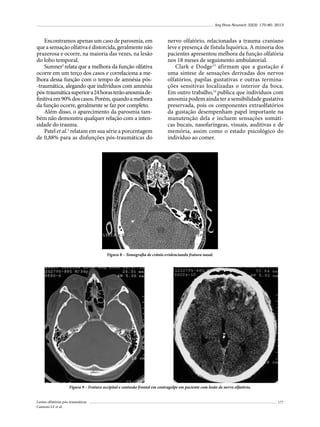 Arq Bras Neurocir 32(3): 170-80, 2013

Encontramos apenas um caso de parosmia, em
que a sensação olfativa é distorcida, geralmente não
prazerosa e ocorre, na maioria das vezes, na lesão
do lobo temporal.
Sumner5 relata que a melhora da função olfativa
ocorre em um terço dos casos e correlaciona a melhora dessa função com o tempo de amnésia pós-traumática, alegando que indivíduos com amnésia
pós-traumática superior a 24 horas terão anosmia definitiva em 90% dos casos. Porém, quando a melhora
da função ocorre, geralmente se faz por completo.
Além disso, o aparecimento da parosmia também não demonstra qualquer relação com a intensidade do trauma.
Patel et al.1 relatam em sua série a porcentagem
de 0,88% para as disfunções pós-traumáticas do

nervo olfatório, relacionadas a trauma craniano
leve e presença de fístula liquórica. A minoria dos
pacientes apresentou melhora da função olfatória
nos 18 meses de seguimento ambulatorial.
Clark e Dodge13 afirmam que a gustação é
uma síntese de sensações derivadas dos nervos
olfatórios, papilas gustativas e outras terminações sensitivas localizadas o interior da boca.
Em outro trabalho,14 publica que indivíduos com
anosmia podem ainda ter a sensibilidade gustativa
preservada, pois os componentes extraolfatórios
da gustação desempenham papel importante na
manutenção dela e incluem sensações somáticas bucais, nasofaríngeas, visuais, auditivas e de
memória, assim como o estado psicológico do
indivíduo ao comer.

Figura 8 – Tomografia de crânio evidenciando fratura nasal.

Figura 9 – Fratura occipital e contusão frontal em contragolpe em paciente com lesão de nervo olfatório.
Lesões olfatórias pós-traumáticas
Cannoni LF et al.

177

 