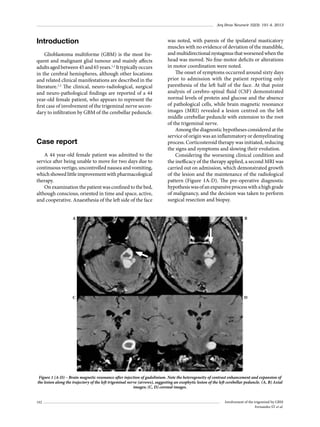 Arq Bras Neurocir 32(3): 191-4, 2013

Introduction
Glioblastoma multiforme (GBM) is the most frequent and malignant glial tumour and mainly affects
adults aged between 45 and 65 years.1,2 It typically occurs
in the cerebral hemispheres, although other locations
and related clinical manifestations are described in the
literature.1,2 The clinical, neuro-radiological, surgical
and neuro-pathological findings are reported of a 44
year-old female patient, who appears to represent the
first case of involvement of the trigeminal nerve secondary to infiltration by GBM of the cerebellar peduncle.

Case report
A 44 year-old female patient was admitted to the
service after being unable to move for two days due to
continuous vertigo, uncontrolled nausea and vomiting,
which showed little improvement with pharmacological
therapy.
On examination the patient was confined to the bed,
although conscious, oriented in time and space, active,
and cooperative. Anaesthesia of the left side of the face

was noted, with paresis of the ipsilateral masticatory
muscles with no evidence of deviation of the mandible,
and multidirectional nystagmus that worsened when the
head was moved. No fine-motor deficits or alterations
in motor coordination were noted.
The onset of symptoms occurred around sixty days
prior to admission with the patient reporting only
paresthesia of the left half of the face. At that point
analysis of cerebro-spinal fluid (CSF) demonstrated
normal levels of protein and glucose and the absence
of pathological cells, while brain magnetic resonance
images (MRI) revealed a lesion centred on the left
middle cerebellar peduncle with extension to the root
of the trigeminal nerve.
Among the diagnostic hypotheses considered at the
service of origin was an inflammatory or demyelinating
process. Corticosteroid therapy was initiated, reducing
the signs and symptoms and slowing their evolution.
Considering the worsening clinical condition and
the inefficacy of the therapy applied, a second MRI was
carried out on admission, which demonstrated growth
of the lesion and the maintenance of the radiological
pattern (Figure 1A-D). The pre-operative diagnostic
hypothesis was of an expansive process with a high grade
of malignancy, and the decision was taken to perform
surgical resection and biopsy.

A

B

C

D

Figure 1 (A-D) – Brain magnetic resonance after injection of gadolinium. Note the heterogeneity of contrast enhancement and expansion of
the lesion along the trajectory of the left trigeminal nerve (arrows), suggesting an exophytic lesion of the left cerebellar peduncle. (A, B) Axial
images; (C, D) coronal images.
192

Involvement of the trigeminal by GBM
Fernandes ST et al.

 