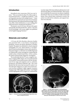 Arq Bras Neurocir 32(3): 195-9, 2013

Introduction
Pericallosal artery aneurysms (PAA) are rare lesions.1-5 They account for less than 5% of all saccular intracranial aneurysms,2,5-8 usually have small size1,2,5,9 and
are frequently associated with multiple lesions.1,3,5 Giant
pericallosal artery aneurysms are even more uncommon
and may present with subarachnoid hemorrhage (SAH),
mass effect, distal embolization or acute swelling after
rapid and massive intraluminal thrombosis.2,3,5,10,11
We present a case of a 58-year-old man with a giant
and partially thrombosed left PAA, which, to the best
of our knowledge, is the twenty-eighth case published
in the English language literature.12

vascular origin of the lesion (left pericallosal artery) and
showed mass effect over both frontal lobes. These exams
also revealed that the aneurysm was almost completely
thrombosed. There was no evidence of other intracranial
lesions. Since clinical status continued to worsen, the
patient was referred for evaluation, and surgical treatment was indicated.
A

Materials and method
A 58-year-old Afro-Brazilian otherwise healthy
man presented with a 2-year history of progressive
headaches, seizures and speech alterations at another
hospital. The patient was submitted to a head computed
tomography (CT) scan, which showed a 4 cm hyperdense frontal interhemispheric lesion with contrast enhancement (Figure 1). The lesion was initially diagnosed
as a bilateral falx cerebri meningioma compressing the
medial surface of both frontal lobes. At the occasion,
the patient refused further diagnostic investigation.
Ten months after the first CT scan, a magnetic resonance imaging (MRI) (Figure 2A) was performed due
to the patient’s clinical deterioration and the development of new signs and symptoms such as: confusion,
paraparesia and bilateral Babinski sign. This exam
showed that the lesion had increased to nearly 6 cm.
The alternative diagnosis of a giant intracranial aneurysm was then considered. Angio-magnetic resonance
imaging (angio-MRI) (Figure 2B) and four-vessel digital
cerebral angiography (DCA) (Figure 2C) confirmed the

Figure 1 – Coronal CT-scan showing left frontal hyperdense mass
lesion crossing the mid line.
196

B

C

Figure 2 – (A) MRI sagital imaging T2 with gadolinium
enhancement with small area of flow void between both frontal
lobes with the presence of thrombotic material. (B) Angio-MRI
showing the relation between the lesion and the pericallosal
vessels. (C) Oblique cerebral angiography: the tiny area of the
aneurysm with blood flow is well seen near its neck.
Giant pericallosal artery
Corrêa JFG et al.

 
