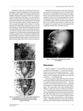 Arq Bras Neurocir 32(3): 195-9, 2013

A bifrontal craniotomy was performed. After interhemispheric approach and ligation of the most anterior
part of the superior sagital sinus, both pericallosal arteries
distally to the lesion were exposed. There was no evidence
of previous bleeding. At this time, it was not possible to
obtain proximal control of the afferent artery and, since
the aneurysm adhered to the medial surfaces of the frontal
lobes and covered the anterior cerebral arteries, the lesion was opened through its dome (Figure 3). Cautious
thrombectomy followed by progressive resection of the
aneurysmatic sac were performed. This procedure allowed
the visualization of the narrow and calcified aneurysm
neck between both pericallosal arteries and left calloso
marginal artery. At this moment, profuse bleeding started.
The left pericallosal artery was temporary clipped, under
pharmacological-protection, and the aneurysm neck was
dissected and closed with two clips, one of them was applied across the blade of the other, in other to reinforce it.

During the first four postoperative days the patient
was drowsy and subsequent recovery was uneventful.
The patient was discharged fourteen days after surgery.
Motor and cognitive functions slowly improved, with
complete recovery over the third postoperative month.
Postoperative DCA showed that the lesion neck was
successfully clipped, without compromising the blood
flow of any cerebral vessel (Figure 4). After one year
the patient was asymptomatic, and both general and
neurological exams were considered normal.

A

B

Figure 4 – Postoperative angiography demonstrating
good clipping.

Discussion

Figure 3 – (A) Operative view, after interhemispheric approach, of
the opened aneurysm sac full of thrombotic material.
(B) Illustration demonstrating the aneurysm sac before
and after its opening.
Giant pericallosal artery
Corrêa JFG et al.

Reports of giant (> 2,5 cm) PAA are extremely
uncommon in the literature2,3,5,13 and are not even mentioned in some series about giant aneurysms.14,15 Since
Drake’s description of a ruptured giant PAA causing
SAH in 1979, 33 additional cases have been reported
until 2012,7,12,16 including this one.
Giant aneurysms are generally proximal in relation
to the circle of Willis. Lesions with more than 2,5 cm are
very seldom encountered in distal arteries.15,17 The rare
incidence of this type of aneurysm may be explained
by its tendency to rupture before they become large or
giant.18 The aneurysmal mass initial swelling may be
related to rapid and massive intraluminal thrombosis.5,7,19 Some of these thrombosed aneurysms continue
to grow probably because of recurrent hemorrhage into
the wall, which allows the lesion’s enlargement up to
giant sizes.10,20 Its clinical presentation usually includes
chronic mass signs and symptoms as well as hemorrhage.17,21 Bleeding, therefore, occurs in only one third of
giant PAA due to their tendency to thrombosis.5 In the
197

 