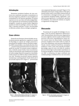 Arq Bras Neurocir 32(3): 200-3, 2013

Introdução
Hematomas intradurais lombares são uma ocorrência rara, usualmente associados a traumatismos ou
discrasias sanguíneas, podendo ter causa iatrogênica ou
eventualmente ser de natureza espontânea. Os autores
reportam um raro caso clínico de lombociatalgia bilateral no seguimento de um hematoma intradural lombar
iatrogênico, causado por punção lombar diagnóstica
quando do estudo de patologia craniana não relacionada. A literatura relevante é revista e são discutidos
os diferentes achados clínicos, etiologia e patogênese.

Caso clínico
Doente do sexo feminino, 46 anos de idade, sem antecedentes pessoais significativos, seguida em consulta
de Neurologia no contexto de vertigens posicionais e
perturbações do equilíbrio, efetuou ressonância magnética (RM) cranioencefálica, com achados descritos como
“(…) possíveis lesões desmielinizantes/vasculares num
quadro de vasculite”. Os restantes exames complementares, incluindo punção lombar, foram inconclusivos.
Ainda em internamento, após instalação de um quadro
de lombociatalgia bilateral de progressiva intensidade,
estudo posterior por RM da coluna vertebral demonstrou uma “formação de provável natureza expansiva
intradural que se prolonga desde o bordo inferior de L4
até ao bordo superior de S1 (Figura 1) – provável lesão

Figura 1 – RM de coluna lombar, ponderação T1, imagem em
corte axial de lesão intradural, com realce ao contraste.
Hematoma intradural lombar iatrogênico
Alves JLM et al.

com componente lipomatoso associado” (Figura 2). Foi
submetida à intervenção cirúrgica eletiva 13 dias após a
punção lombar, tendo-se procedido à laminectomia de
L5, à durotomia e à drenagem da lesão, que se revelou
um hematoma intradural lombar, organizado e com
efeito de massa significativo. A evolução pós-operatória
foi satisfatória, com ausência de sintomas ou sequelas
no seguimento em longo prazo.

Discussão
Na presença de um quadro de lombalgia e/ou ciatalgia, a lista de possíveis diagnósticos diferenciais é
vasta: hérnia/protusão discal; processos degenerativos
de causas congênitas; estenose canalar ou listesis lombar;
processos infecciosos (espondilodiscite, herpes-zóster); tumores ósseos da coluna lombar; metastização;
processos neoplásicos dos tecidos moles no trajeto do
nervo (intra-abdominais, coxa); processos inflamatórios
(bursite, miosite); síndrome do piriforme, neuropatias
periféricas e outros. Como causa específica de lombalgia/ciatalgia, apesar de raros, são ainda de considerar
processos hemorrágicos intracanalares espontâneos ou
de natureza iatrogênica. Primeiro descritos por Jackson
em 1869,1 os hematomas do ráquis constituem uma
entidade patológica multifatorial rara, mas merecedora

Figura 2 – RM de coluna lombar, ponderação T2, imagem em
corte axial de lesão intradural.
201

 