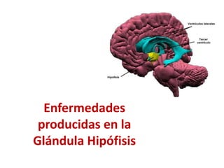 Enfermedades
producidas en la
Glándula Hipófisis
 