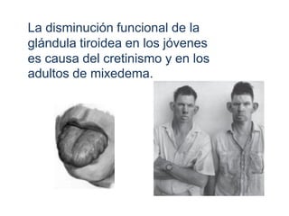 La disminución funcional de la
glándula tiroidea en los jóvenes
es causa del cretinismo y en los
adultos de mixedema.
 