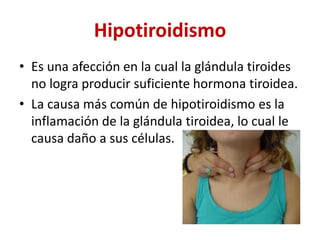 Hipotiroidismo
• Es una afección en la cual la glándula tiroides
no logra producir suficiente hormona tiroidea.
• La causa más común de hipotiroidismo es la
inflamación de la glándula tiroidea, lo cual le
causa daño a sus células.
 