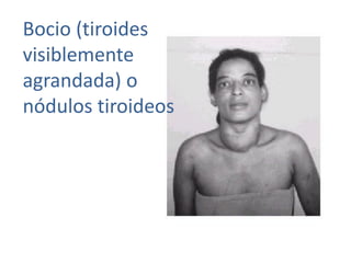 Bocio (tiroides
visiblemente
agrandada) o
nódulos tiroideos
 