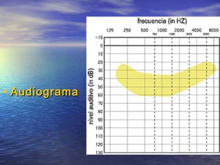 • Audiograma

 