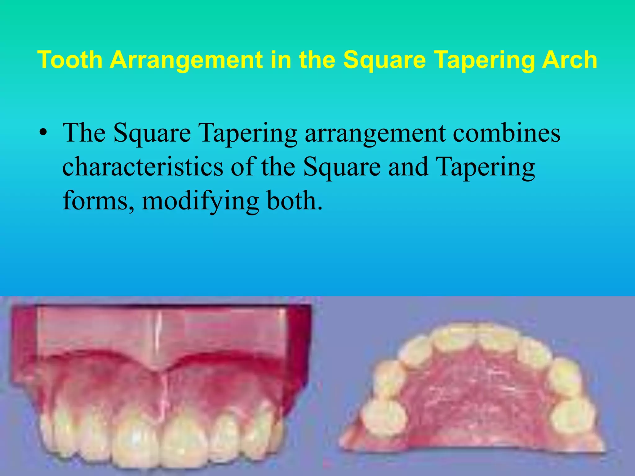 Arrangement of anterior artificial teeth | PPTX