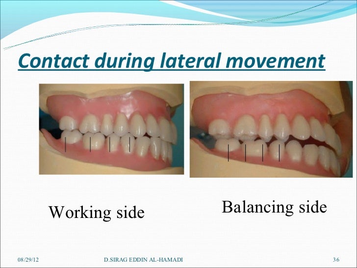 Arrangement of artificial teeth 1