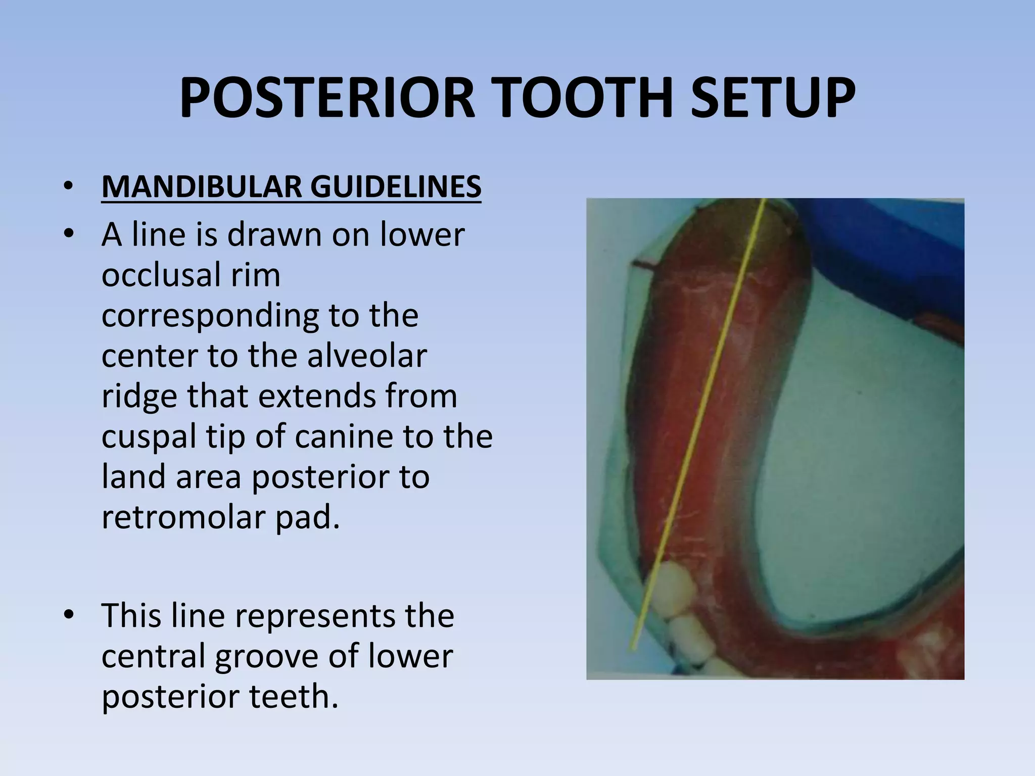 Teeth Setting Arrangement of artificial teeth | PPTX