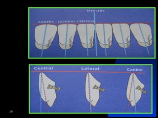 <ul><li>Lower anterior teeth </li></ul>