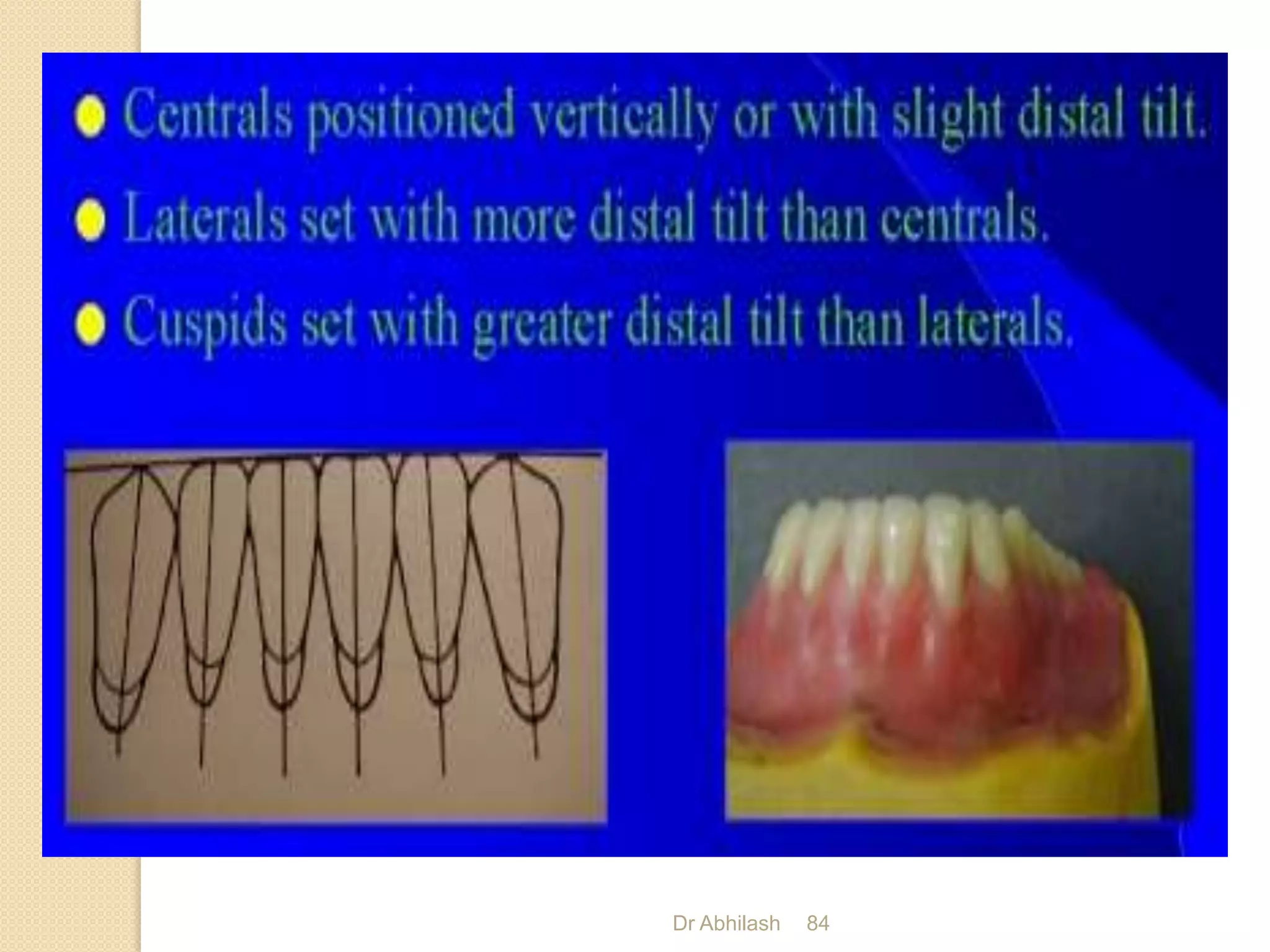 Teeth Setting Arrangement of teeth in complete denture | PPTX